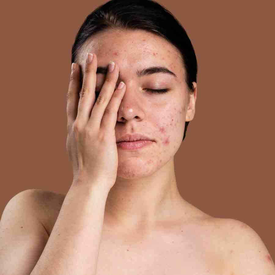 Are you suffering from acne on the chin, what are the reasons