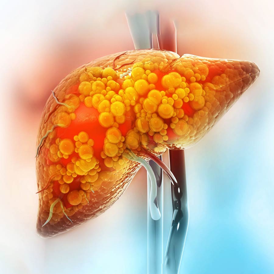 4 snacking option that will help reduce Fatty liver  dgtl