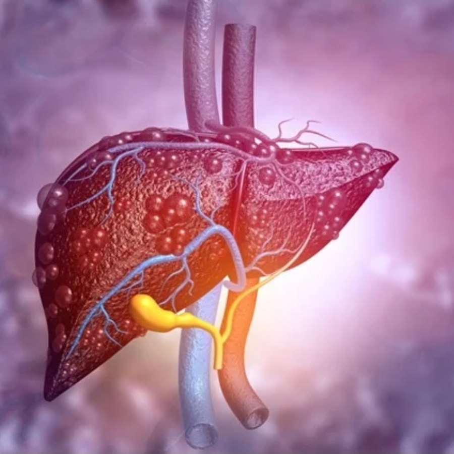এখনও ফ্যাটি লিভারের ওষুধ আবিষ্কৃত হয়নি।