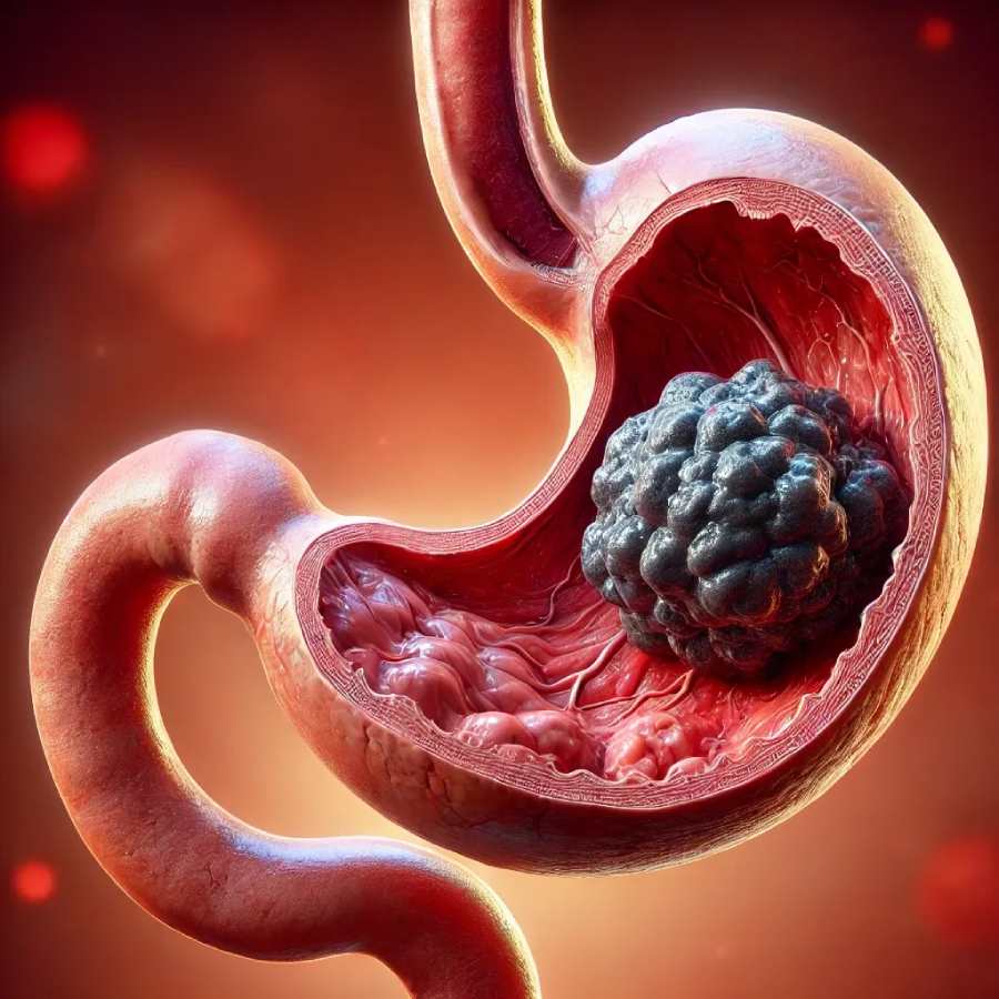 1.56 crore people born in specific 9years may have developed the risk of Gastric Cancer dgtl