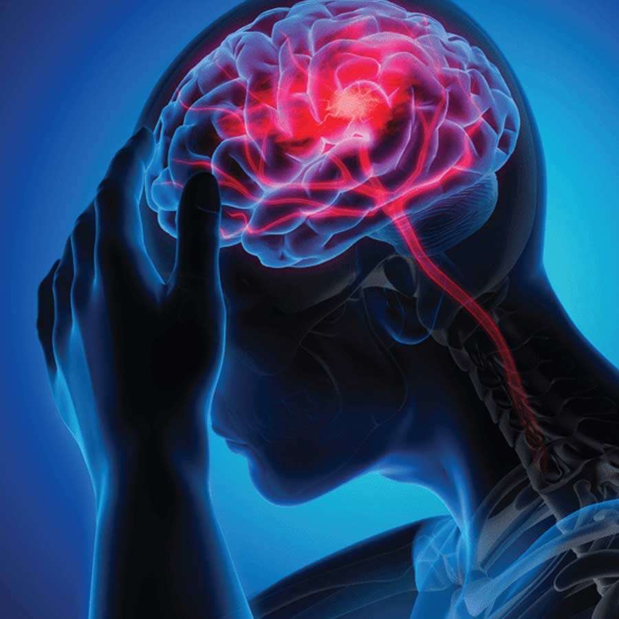 How to identify stroke with 6 letters that can save patients dgtl