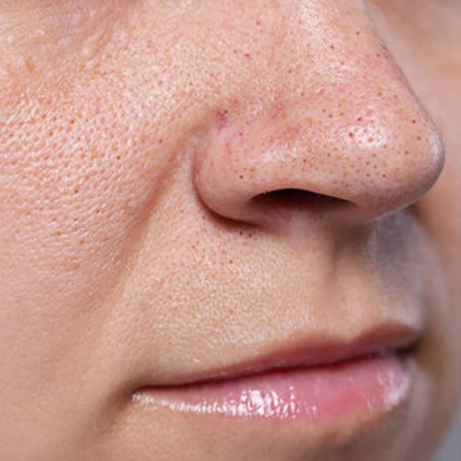 How to remove blackheads instantly from face with coffee at home dgtl