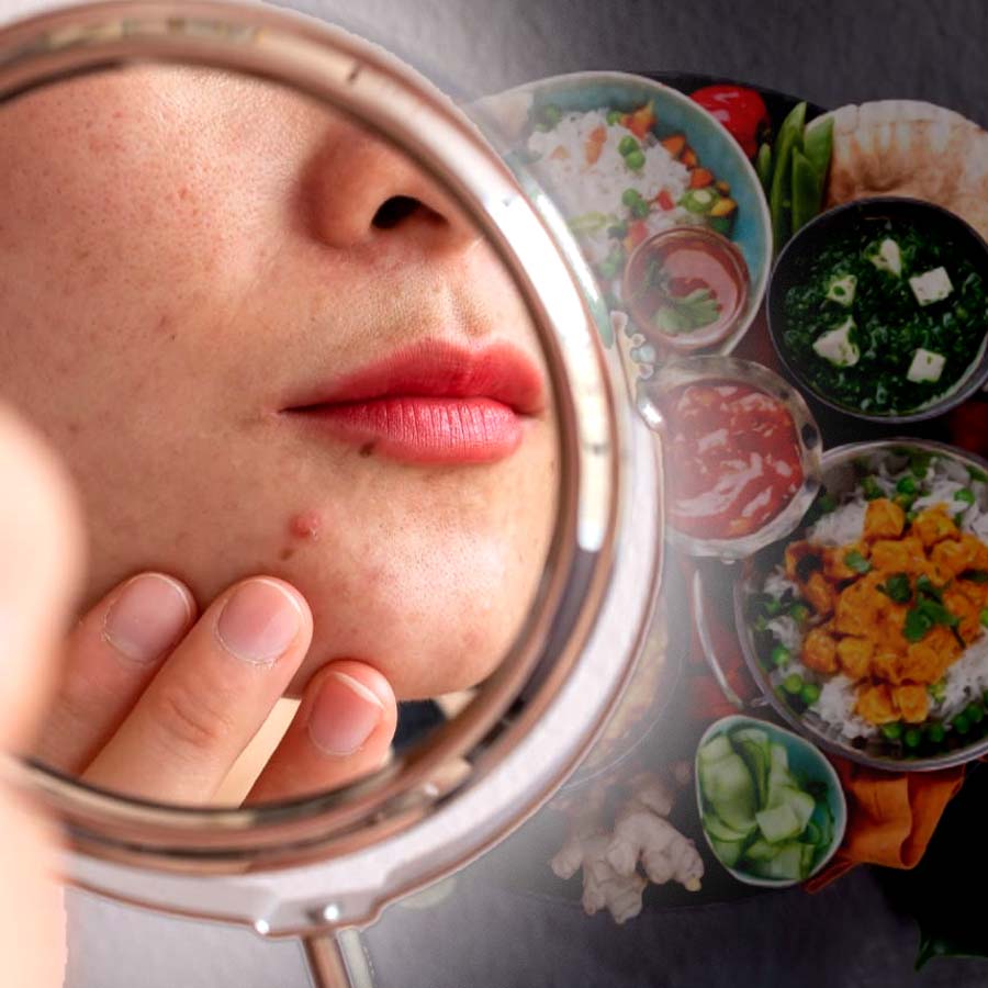 Avoid these foods which are the source of your acne dgtl
