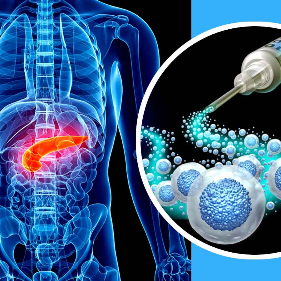 New Cell Therapy technique could free people with Diabetes from taking insulin injections
