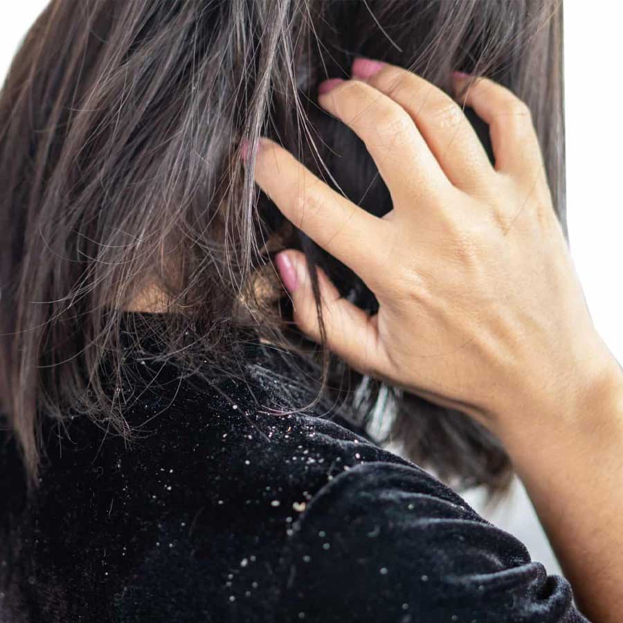 How to use lemon to get better results for dandruff problem dgtl