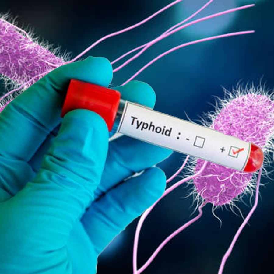 According to New Research Typhoid Fever is evolving extensive drug resistance