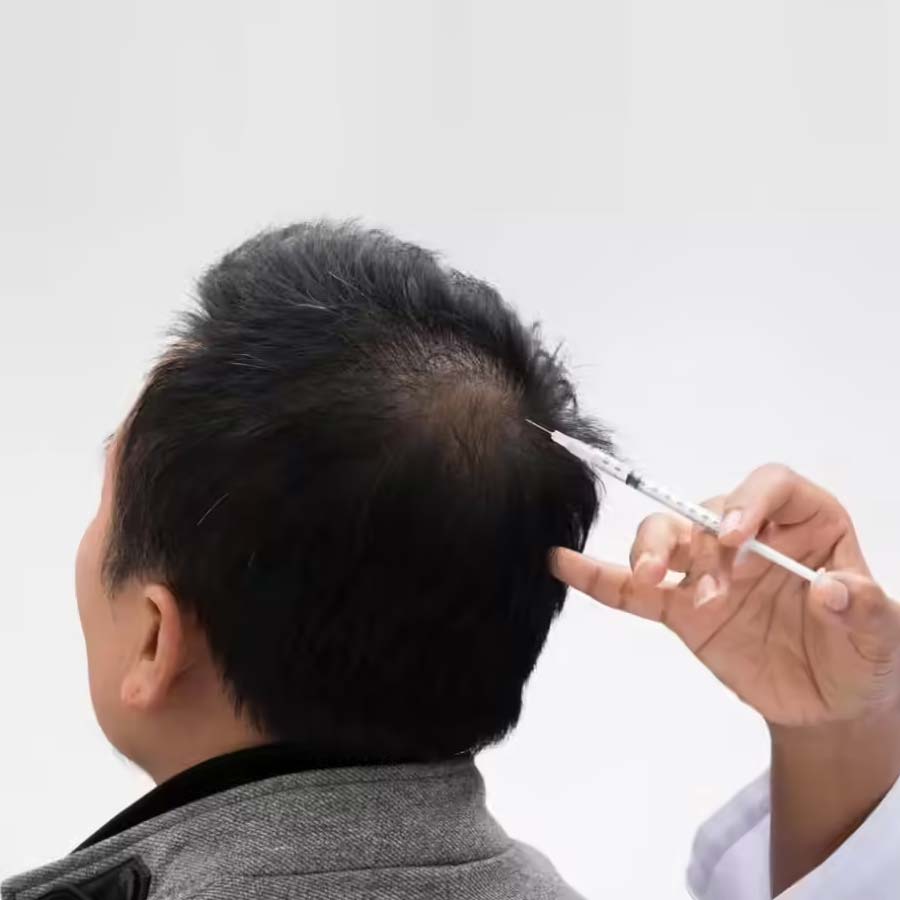 Scientists stumbled upon new DNA Sugar Gel treatment for hereditary-patterned baldness