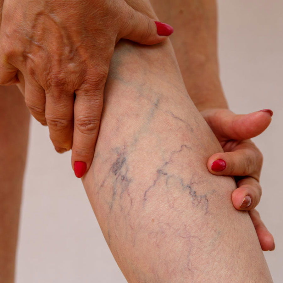 Deep vein thrombosis can occur for a variety of reasons, which can be fatal in some cases