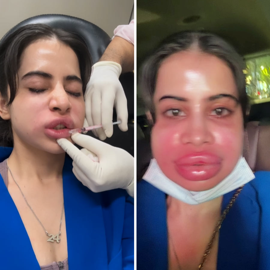 Influencer Uorfi Javed shares her video after removing her lip fillers and her fans are worried dgtl