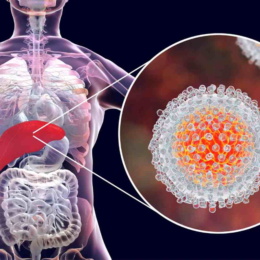 Pune has been witnessing a surge in hepatitis A cases, what are the symptoms and treatment of this disease