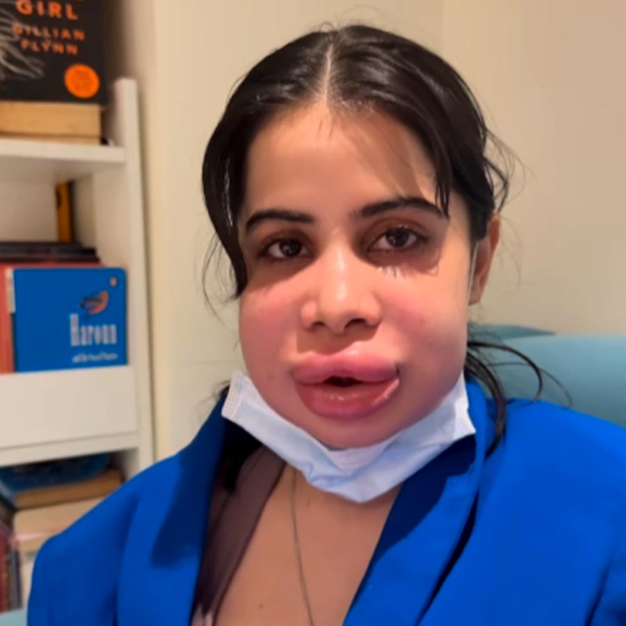 Uorrfi Javed shares her a video of her swollen face and fans are worried dgtl