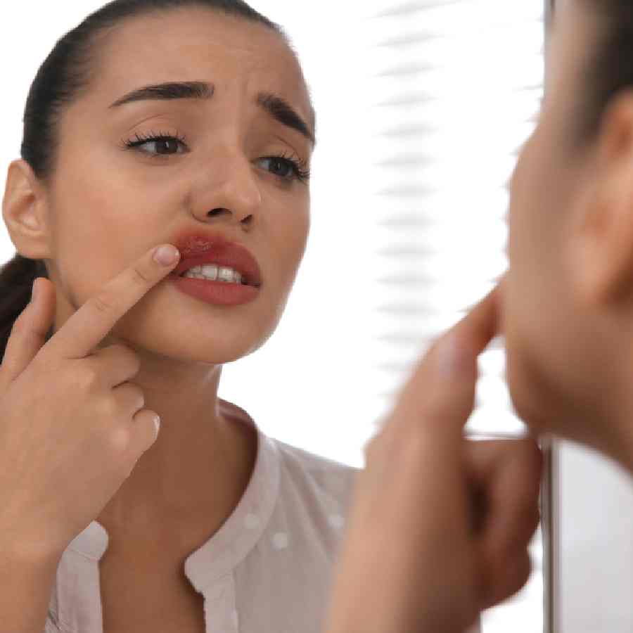 Five home remedies to cure mouth ulcer dgtl