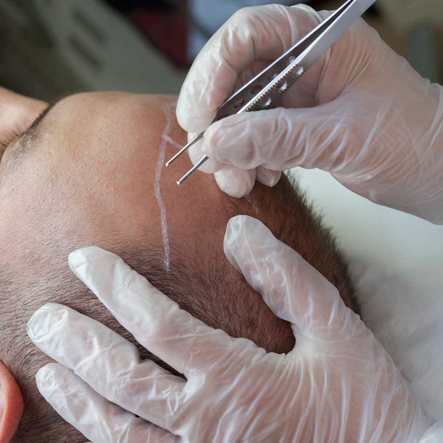 An influencer ended up with swollen face after hair transplant
