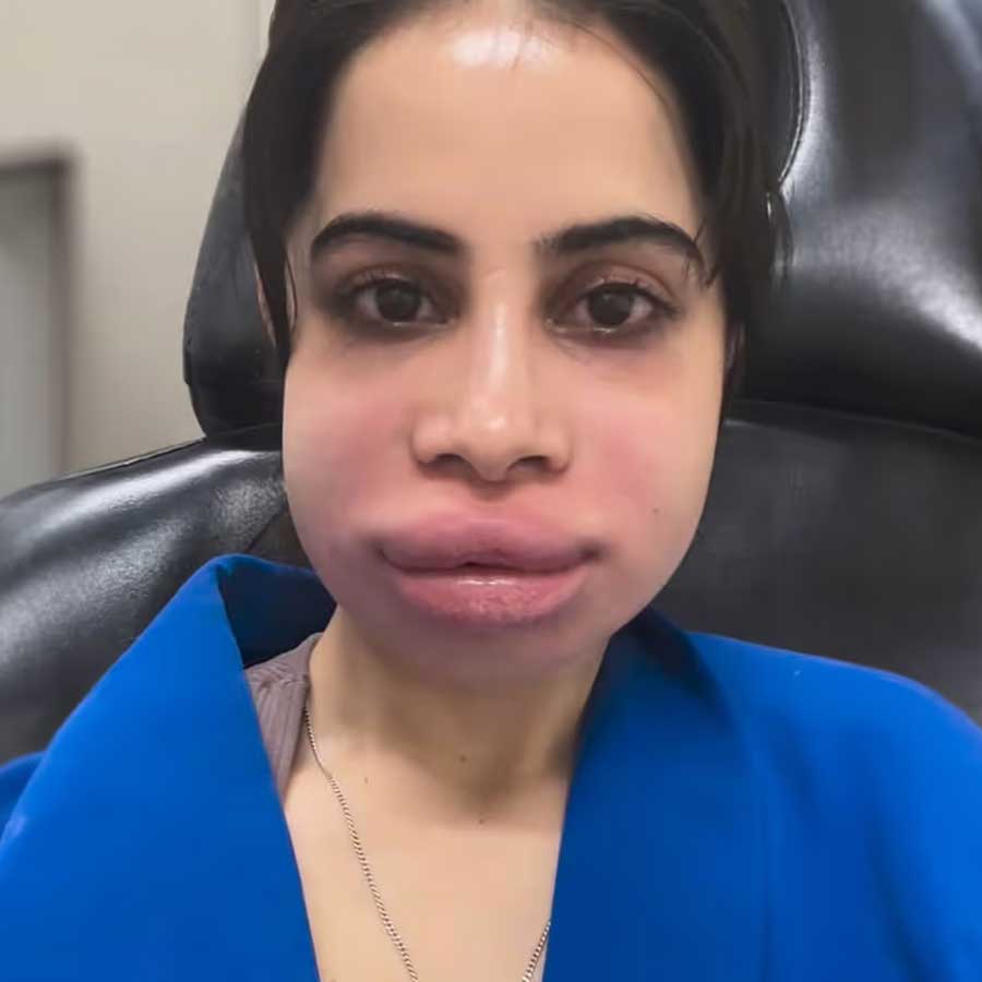 Are Lip Fillers safe, what are the risk associated with it