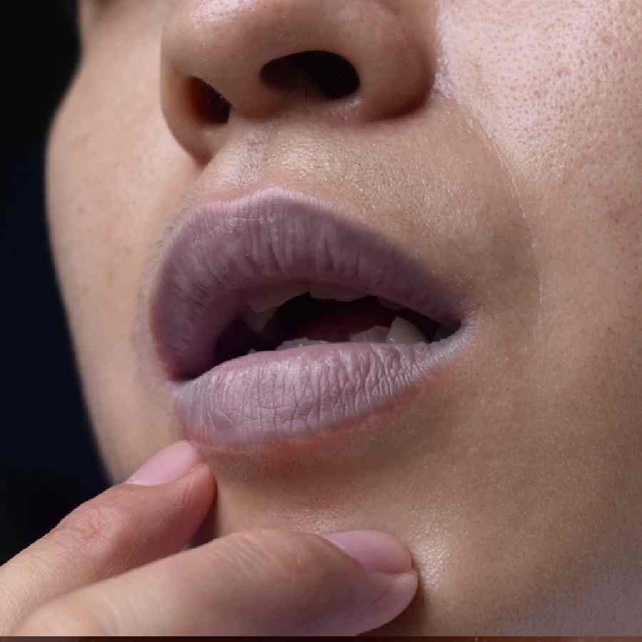 Not only smoking, there could be multiple reasons behind your dark lips dgtl