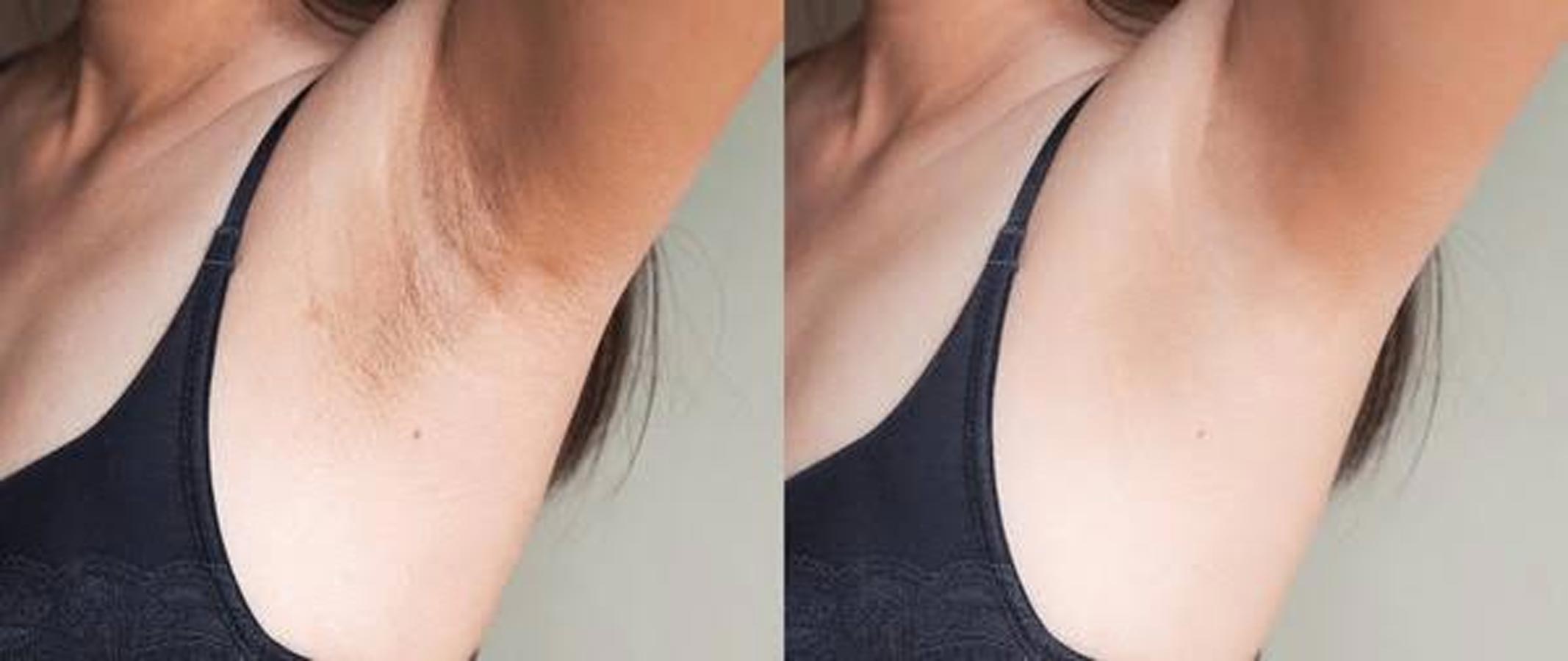 বাহুমূলের দাগ অপসারণের জন্য ঘরোয়া টোটকা প্রয়োগ করুন।