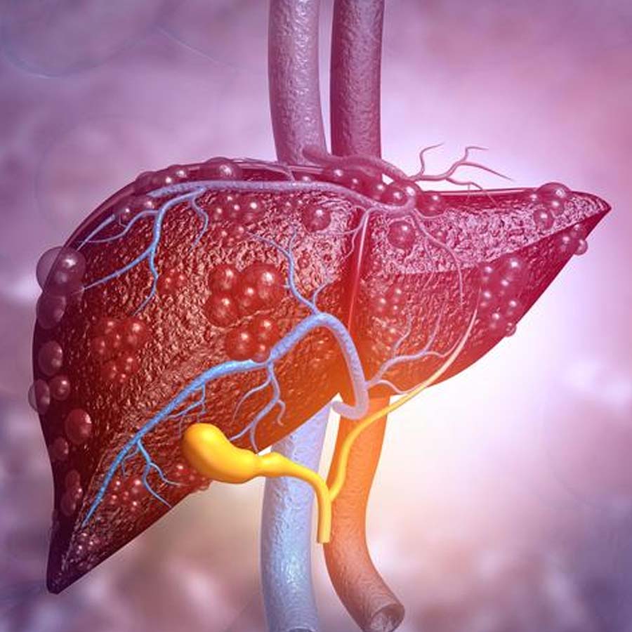 A study finds that many liver cancer cases can be prevented by tackling hepatitis and alcohol use