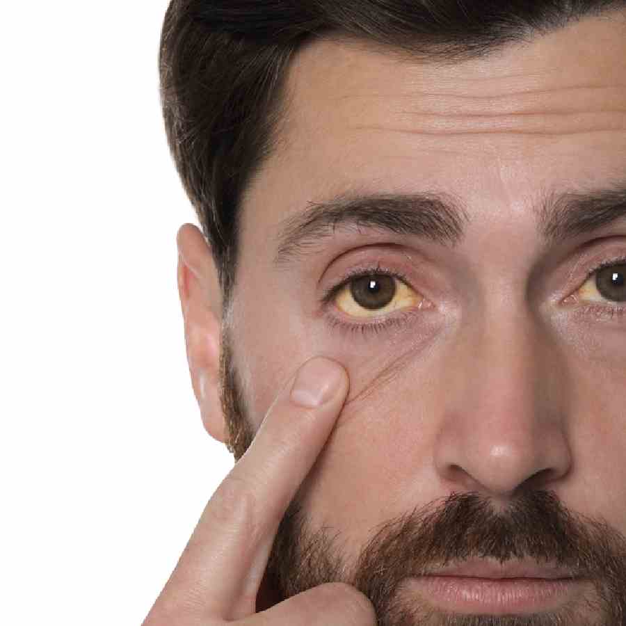 Warning signs of high cholesterol in your eyes that you should not ignore dgtl