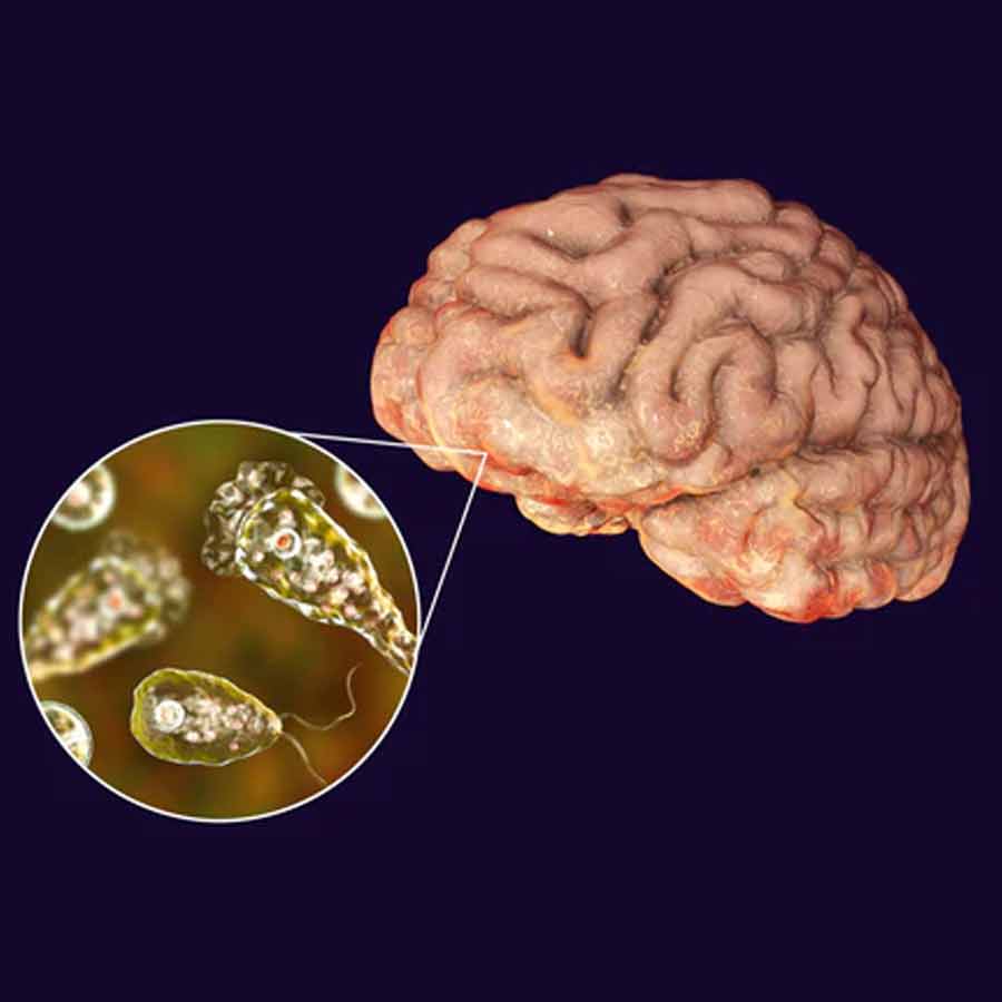 Monsoon rains have led to a sharp rise in Neurocysticercosis cases caused by tapeworm infection in the brain