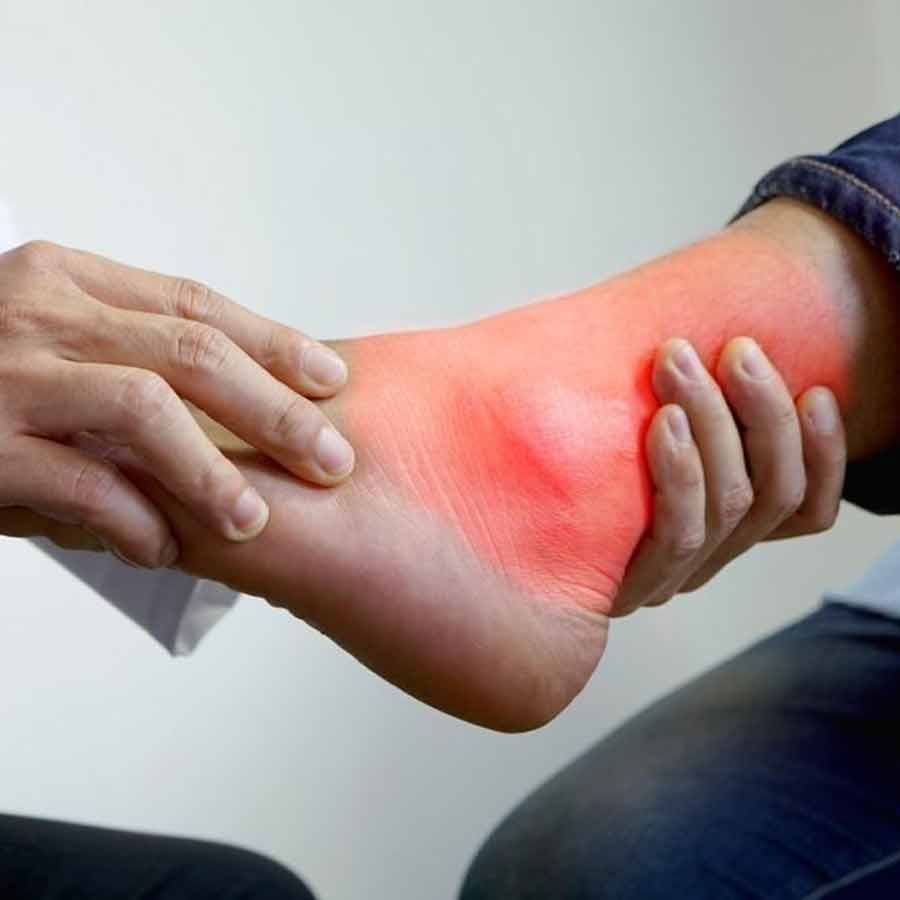 Watch for these 5 early signs of high uric acid in the body