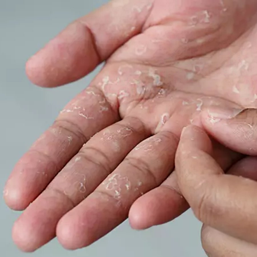 what should you do if you have spilled fevikwik on your hand and the glue doesn't come out dgtl