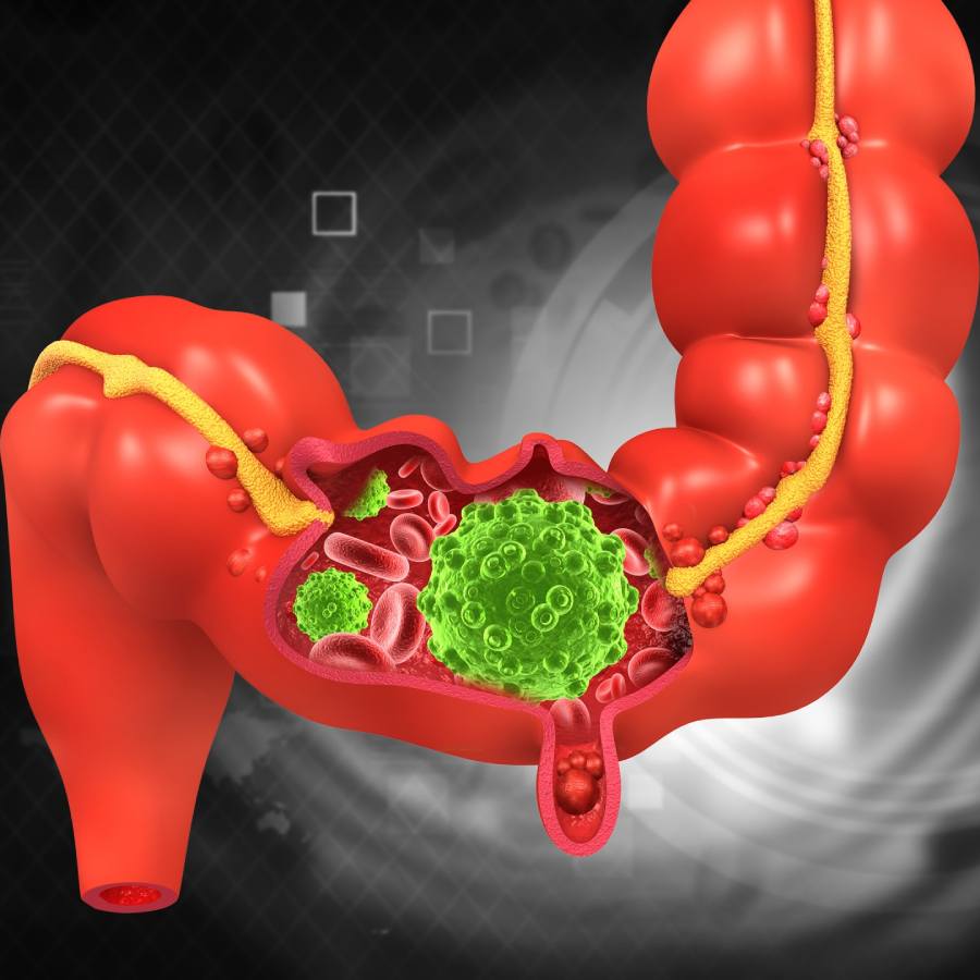 কোলন হল অন্ত্রের সেই অংশ, যেখানে খাবার হজম হওয়ার এবং তা থেকে পুষ্টিরস শোষণ করে নেওয়ার পরে শরীর বর্জ্য হিসাবে জমিয়ে রেখে। 