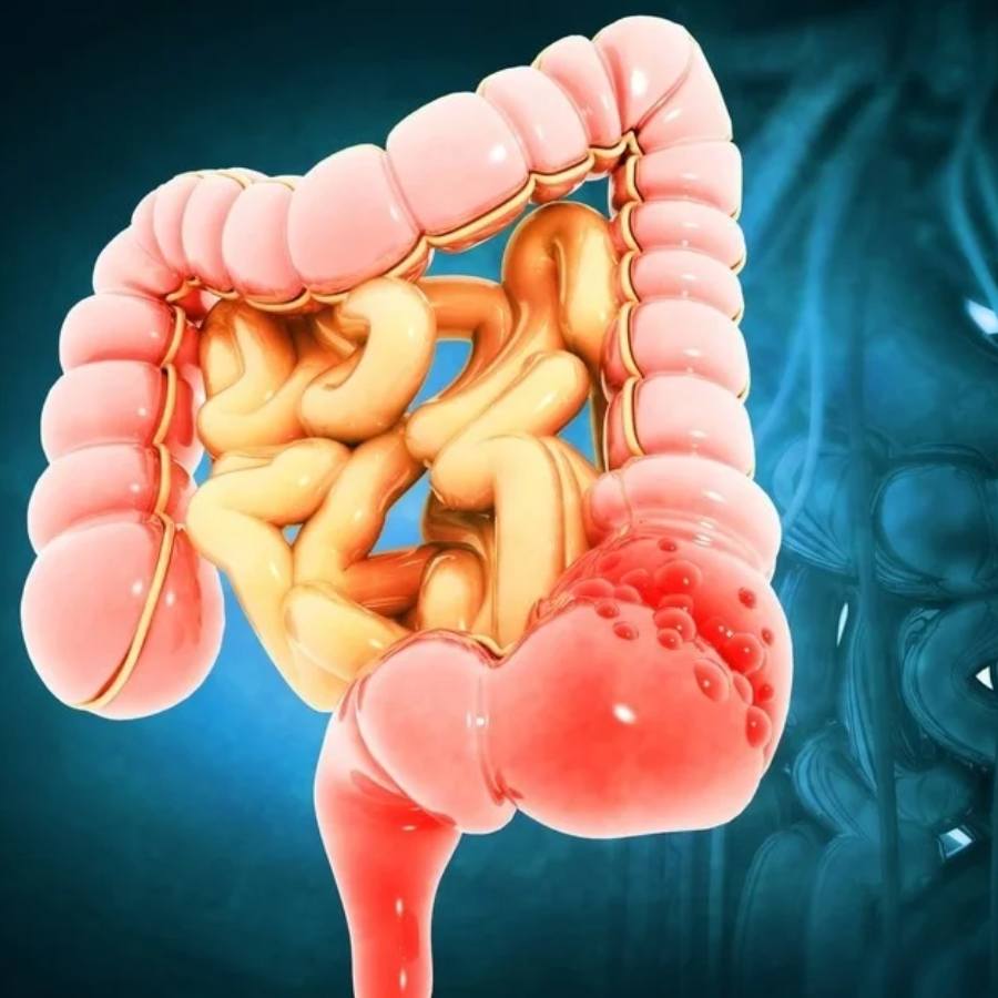 5 Symptoms of Colon Cancer You should be aware of dgtl