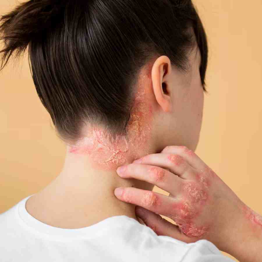 Surge in Moisture poses infections such as ringworm, eczema and scabies