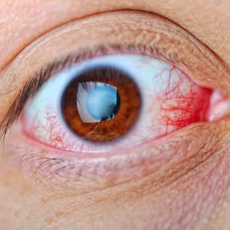 New Study says Weight loss Medicines double the risk of diabetic patients developing age-related macular degeneration