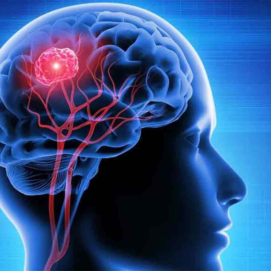 Raising awareness is the way to cure brain tumors