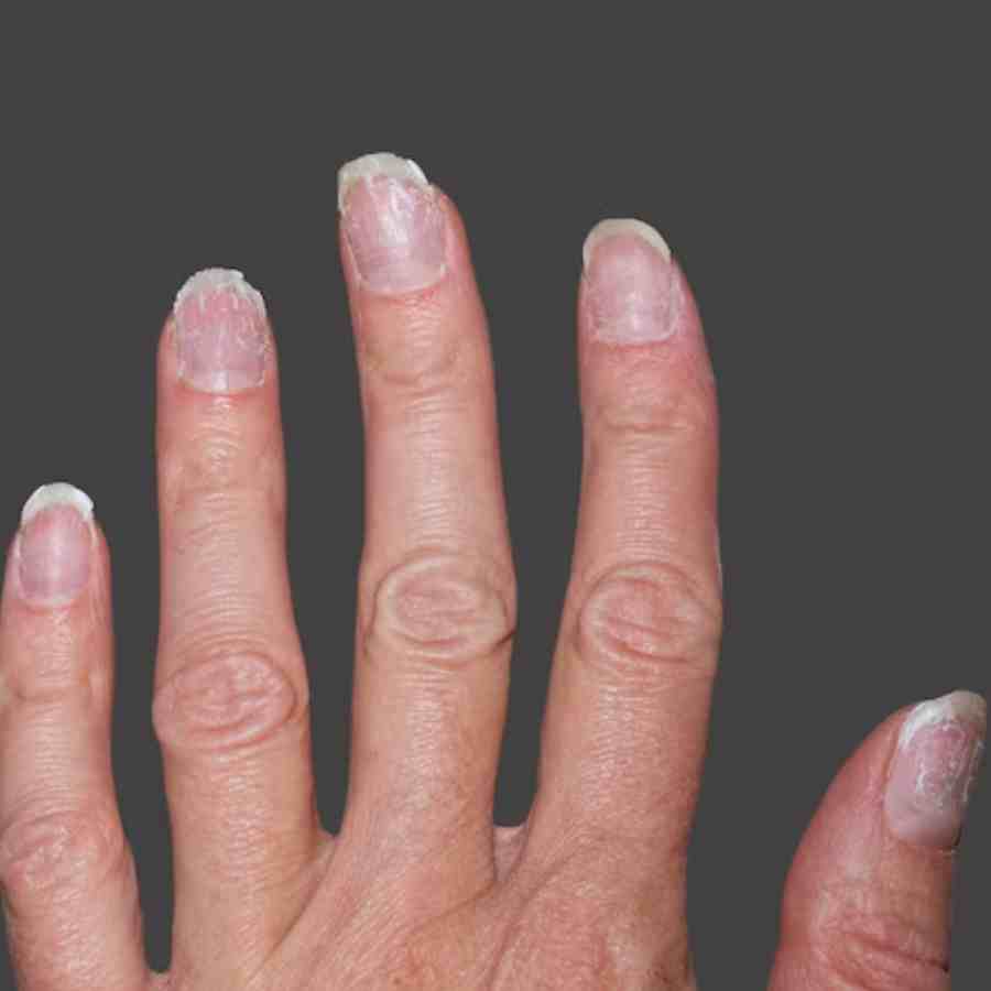 Nail colour and shape detect early signs of illness, 5 signs to look out for
