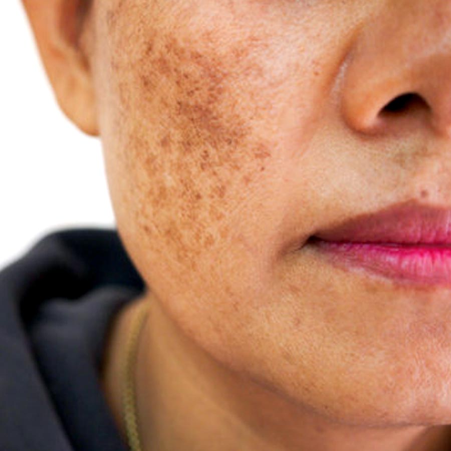 Homemade natural mask to prevent hyperpigmentation by using 3 ingredients dgtl