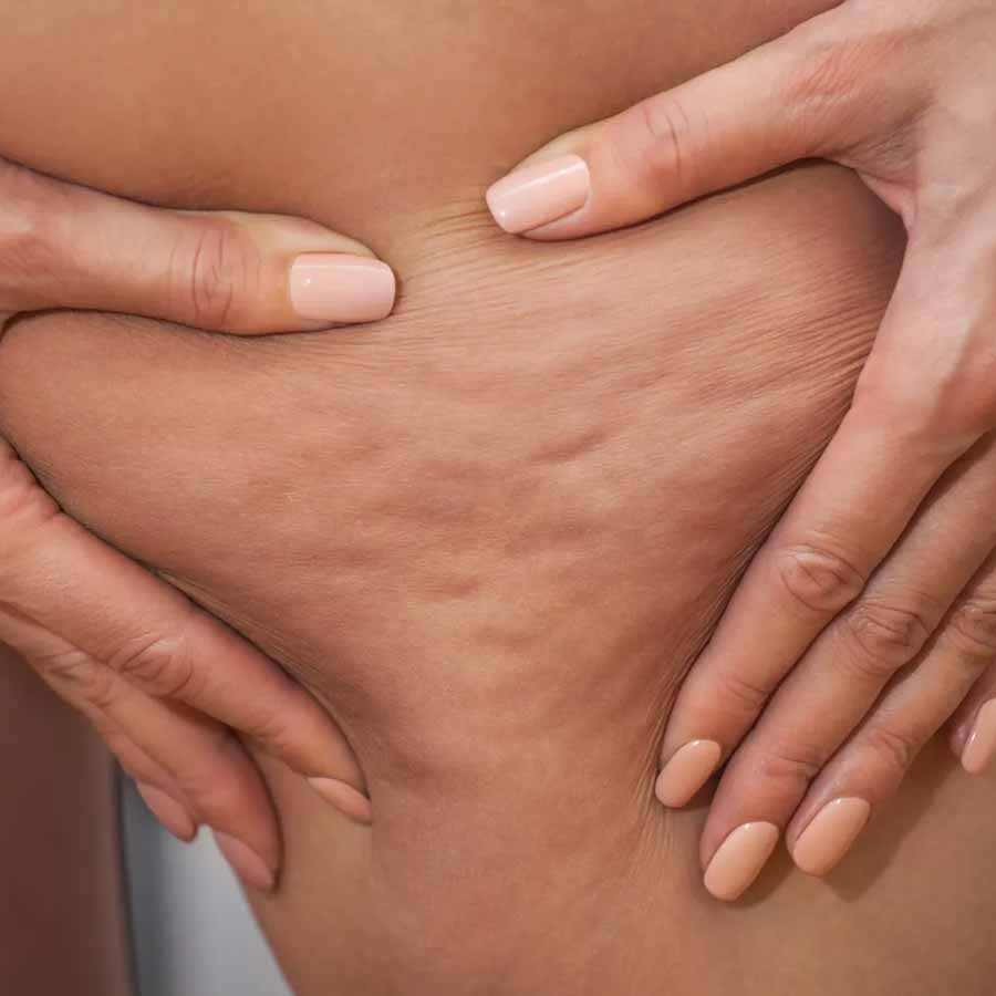 What is the difference between normal fat and Lipedema