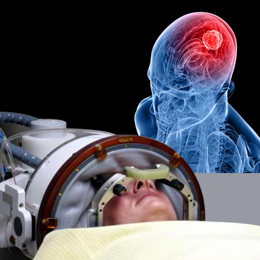 New Non-Invasive Therapy is coming to remove Brain Tumour