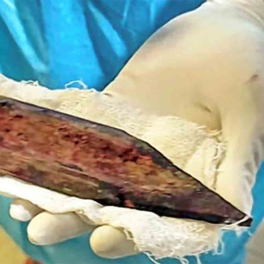 Jalpaiguri Medical Super Speciality Hospital successfully treated a person who was admitted with wood pierced in his lungs