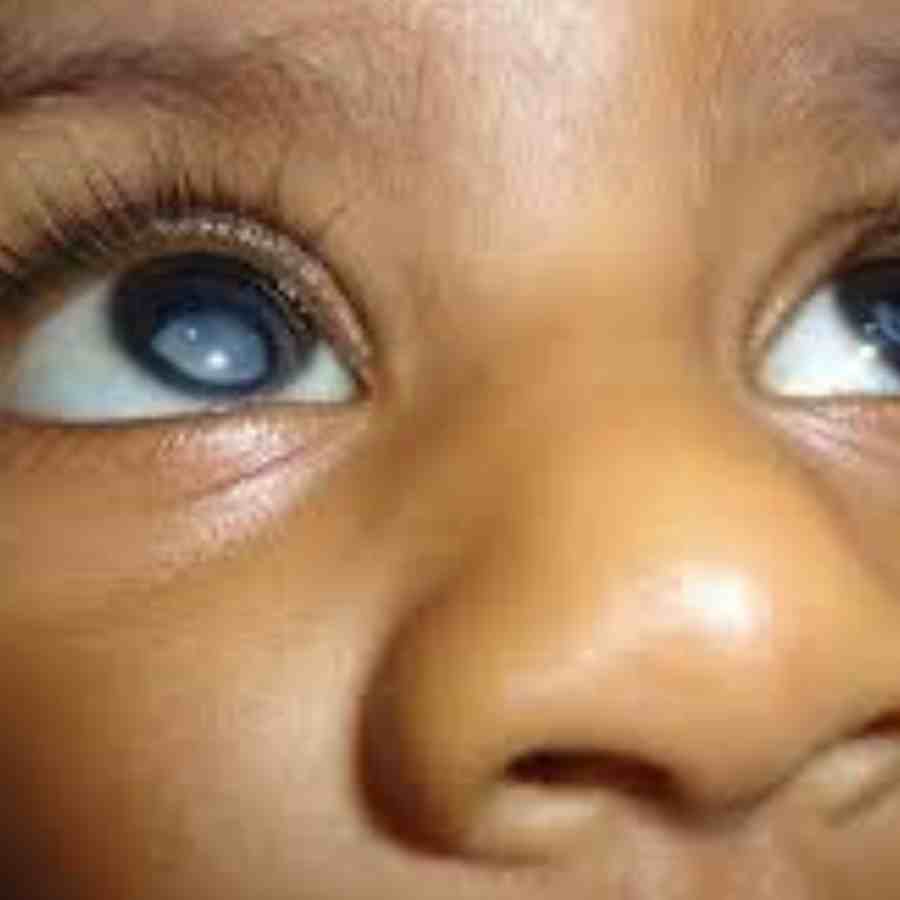 একচোখে বা দু'চোখে মণির উপর সাদা তুলোর মতো আস্তরণ পড়ে।