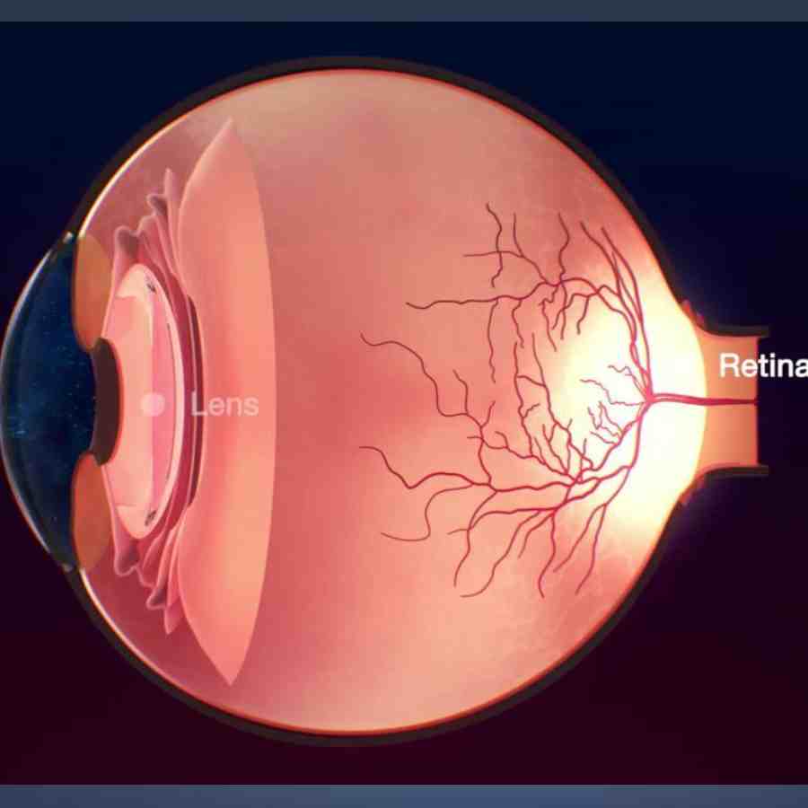 লেন্সের ভিতর দিয়ে আলো চলাচলের পথটা বন্ধ হয়ে যায়।