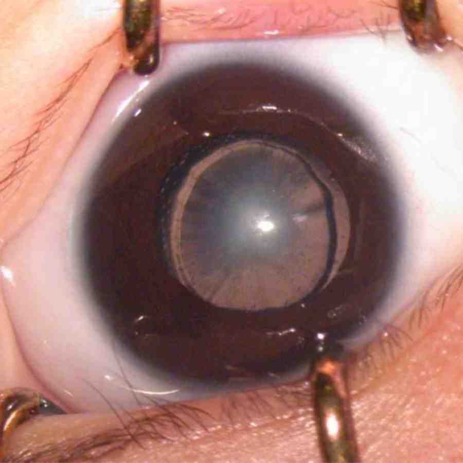 অস্ত্রোপচার করে মণির উপর জমে থাকা তুলোর মতো স্তরটা বার করে দেওয়া হয়।