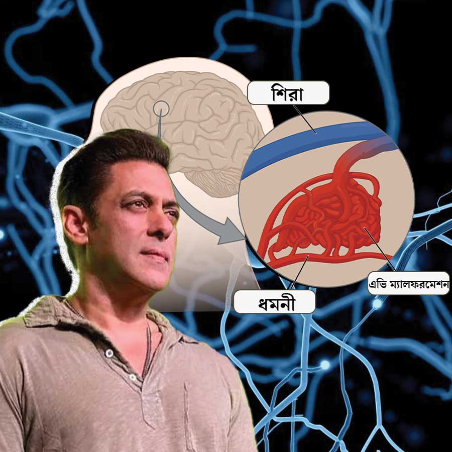 Salman Khan reveals that he is battling with a brain aneurysm dgtl