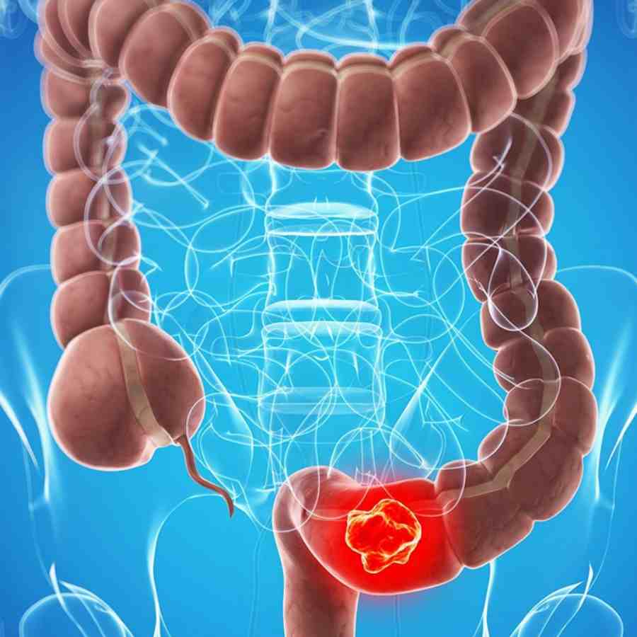 How to tell the difference between colon cancer and haemorrhoids