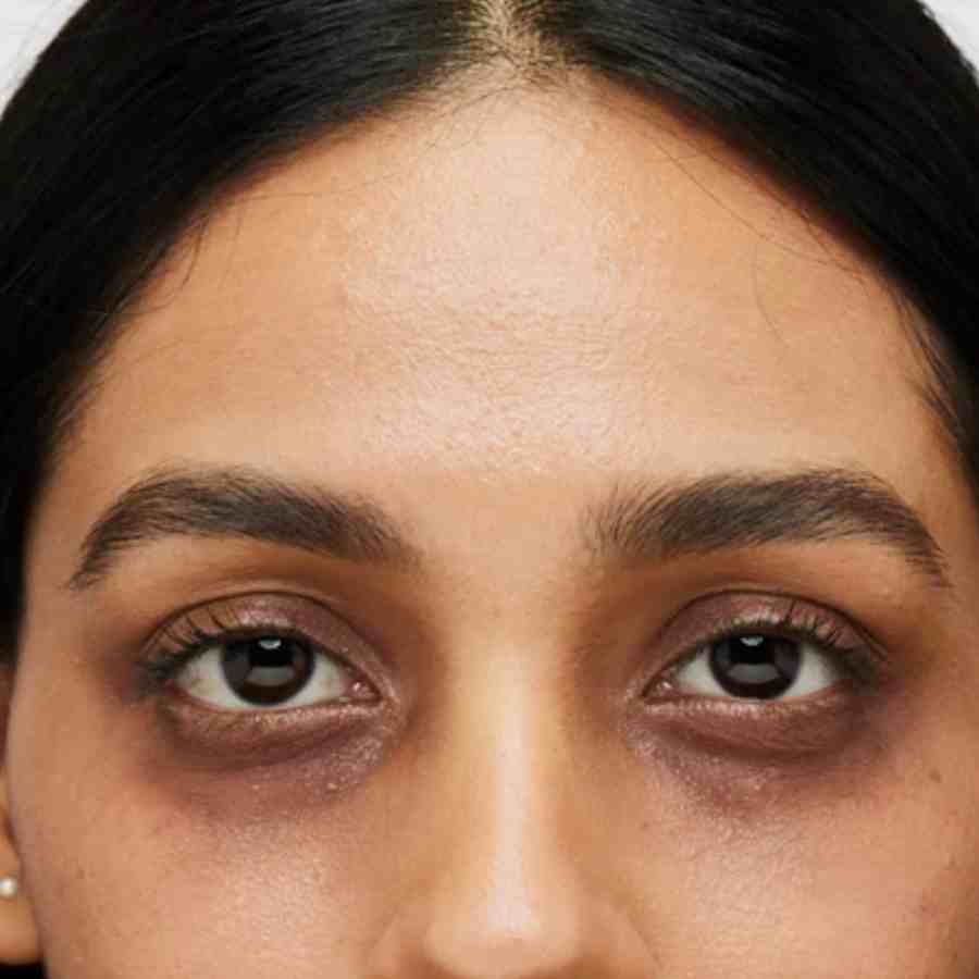 How to use peppermint oil for dark circles dgtl