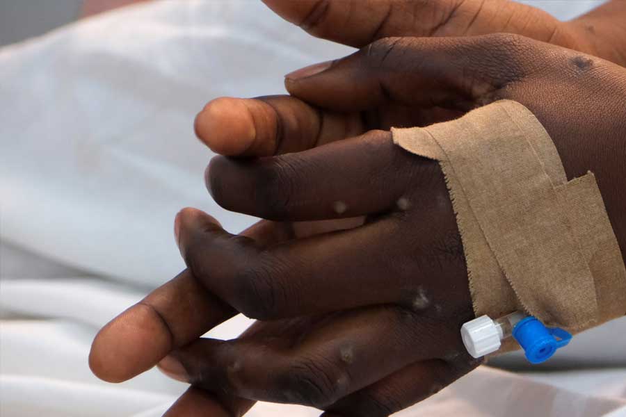 mysterious illness has emerged in Congo 