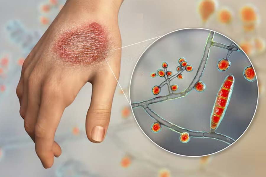 Ringworm disease rises among older adults in India