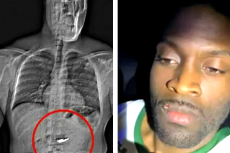 Jewel thief in Florida swallowed earrings