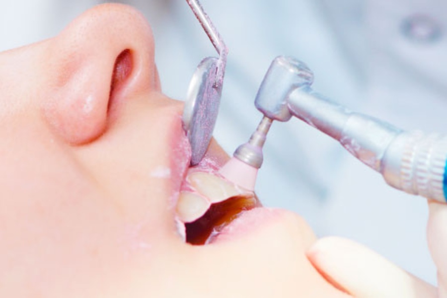 Tips of dental oral care, how to remove stains from teeth at home