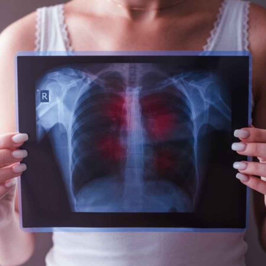 Dietary practices to support recovery from tuberculosis