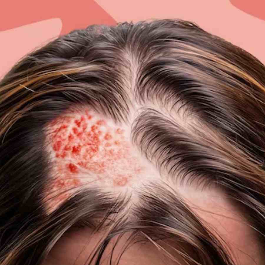 How to protect your scalp from sunburn