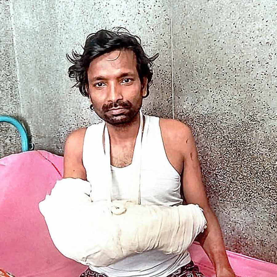 A young man's severed hand has healed after receiving treatment at SSKM Hospital