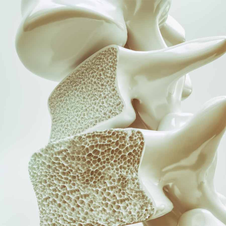 how to deal with brittle bones disease