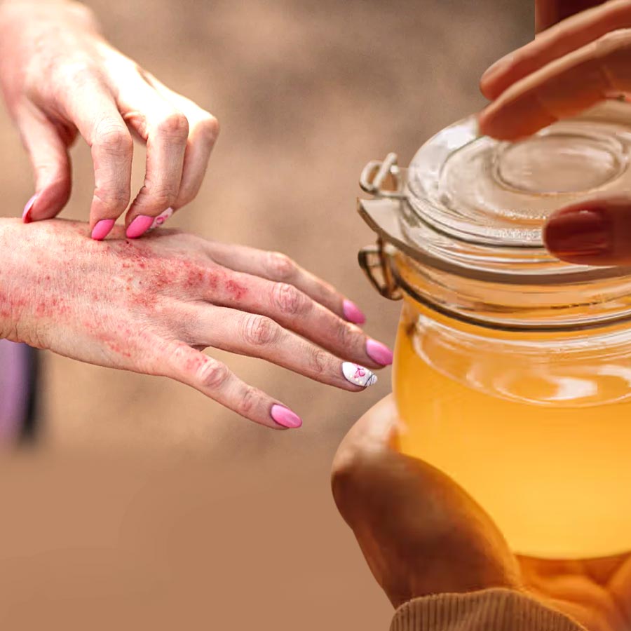 Ghee is the natural remedy for eczema, how to use for other skin diseases dgtl